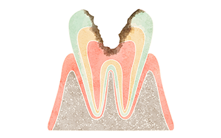 進行してしまった虫歯は歯の根の治療が必要