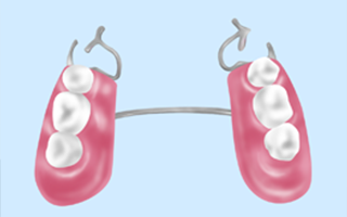 金属で固定する部分入れ歯