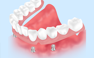 インプラントで固定するインプラントオーバーデンチャー