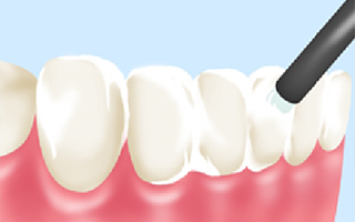 フッ素塗布で虫歯に強い歯を目指す