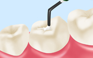 虫歯になりやすい奥歯をシーラントで守る